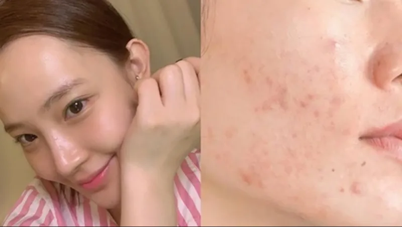 Việc nặn lại hoặc bóc vảy non có thể làm tổn thương da sâu hơn và tăng nguy cơ thâm sẹo.
